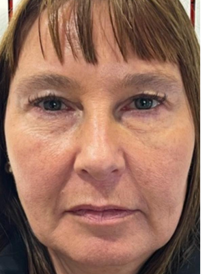 Caso 1 — antes de blefaroplastia