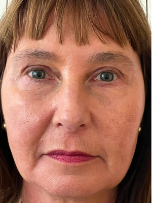 Caso 1 — después de blefaroplastia