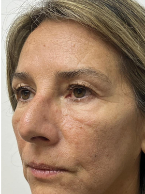 Caso 2 — antes de blefaroplastia