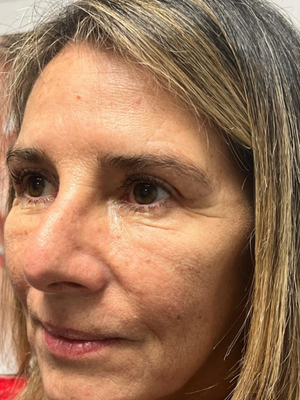 Caso 2 — después de blefaroplastia